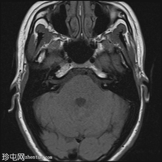 急性面神经炎