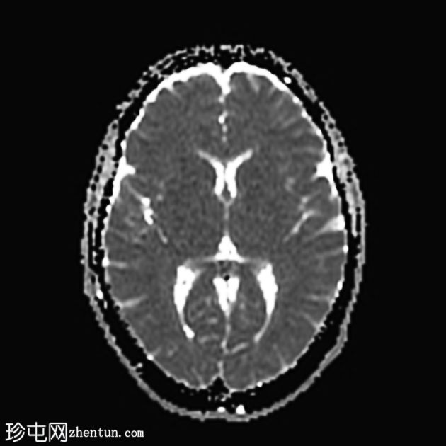 急性面神经炎