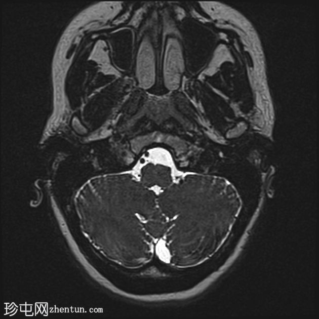 急性面神经炎