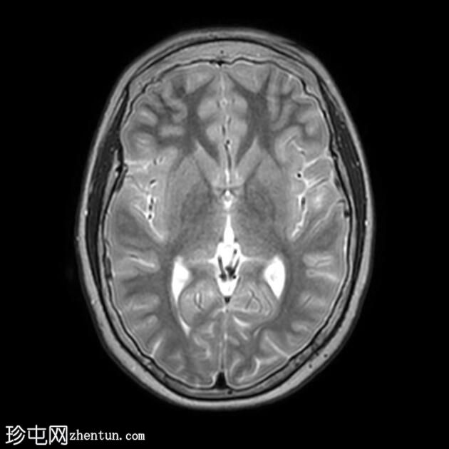 下丘脑错构瘤