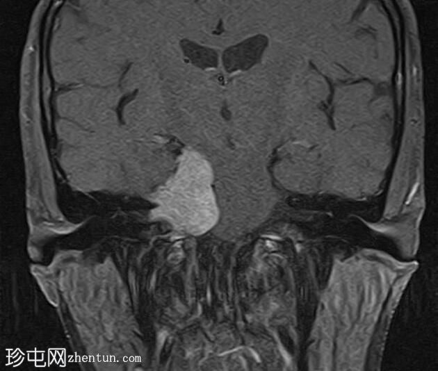 脑膜瘤 - 小脑桥脑角