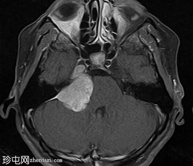 脑膜瘤 - 小脑桥脑角