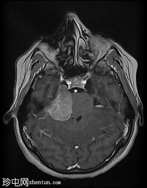 脑膜瘤 - 小脑桥脑角