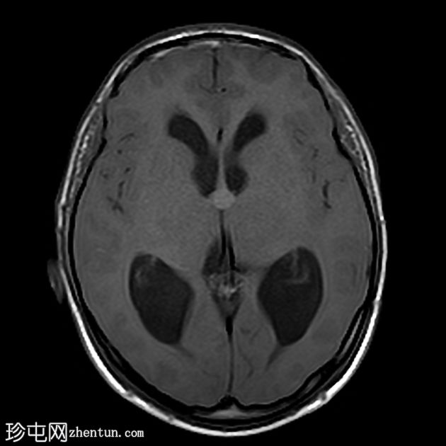 阻塞性脑积水伴有第三脑室胶状囊肿