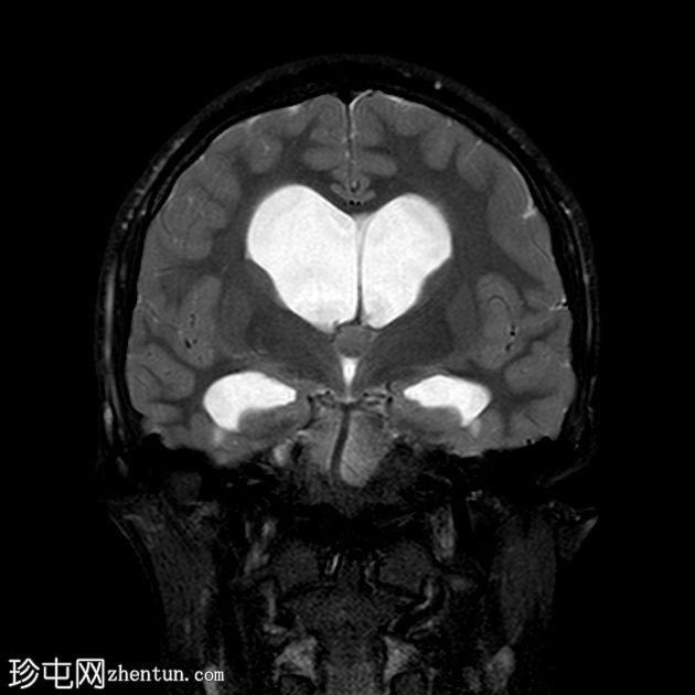 阻塞性脑积水伴有第三脑室胶状囊肿