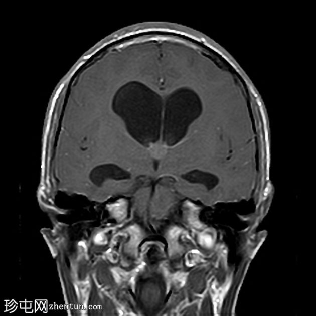 阻塞性脑积水伴有第三脑室胶状囊肿