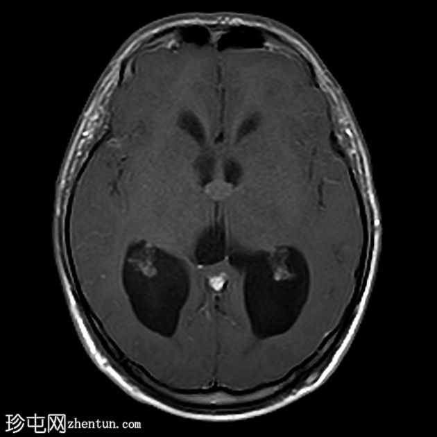 阻塞性脑积水伴有第三脑室胶状囊肿