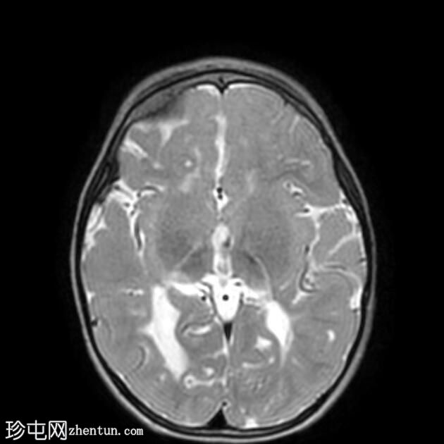 脑室周围白质软化