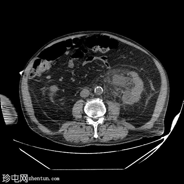 肾周组织腹股沟疝