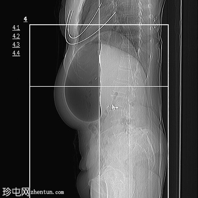 大型减肥胃球囊导致肾梗塞