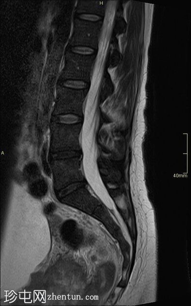 腰椎 MRI 检查发现阴道恶性肿瘤