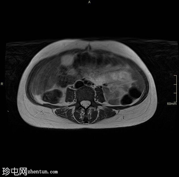 腰椎 MRI 检查发现阴道恶性肿瘤