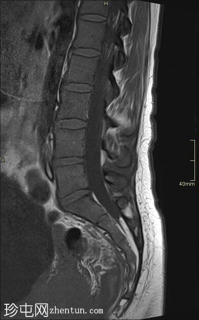 腰椎 MRI 检查发现阴道恶性肿瘤