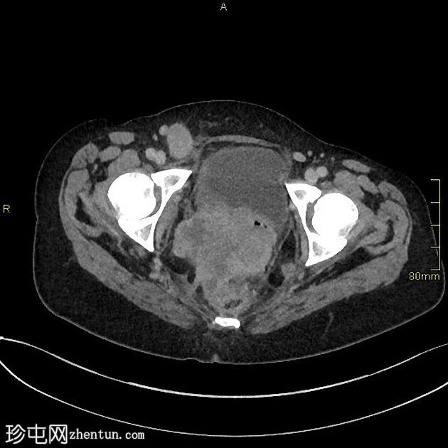 腰椎 MRI 检查发现阴道恶性肿瘤