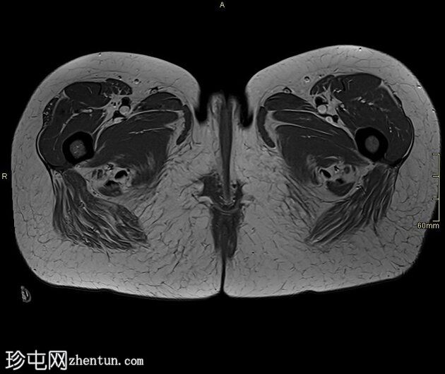 腰椎 MRI 检查发现阴道恶性肿瘤