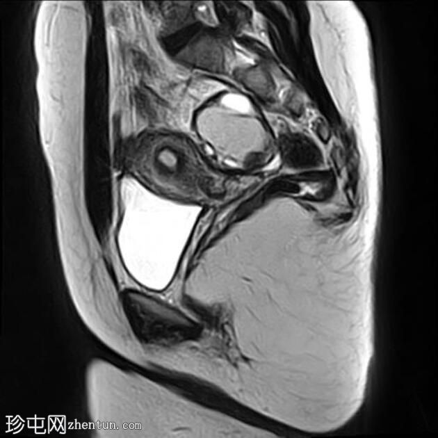 卵巢子宫内膜异位症-T2黑点征