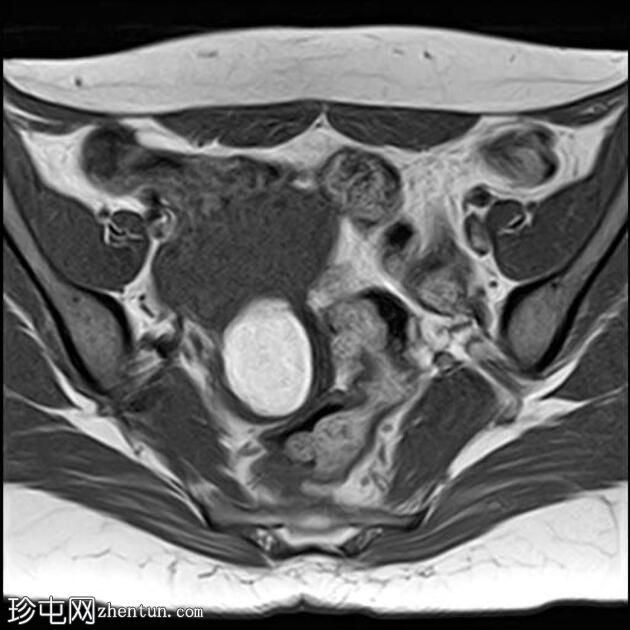 卵巢子宫内膜异位症-T2黑点征