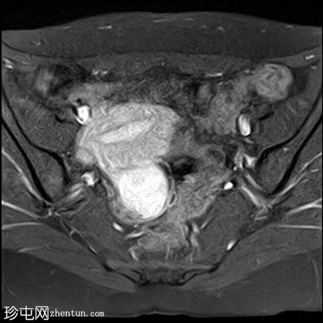 卵巢子宫内膜异位症-T2黑点征
