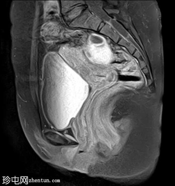 卵巢子宫内膜异位症-T2黑点征