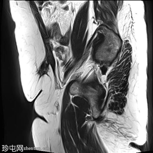 疤痕子宫内膜异位症