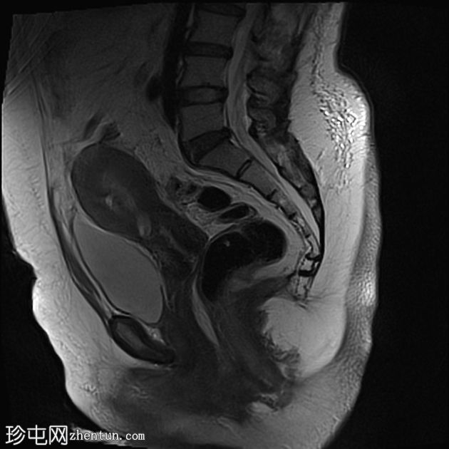 深部盆腔子宫内膜异位症