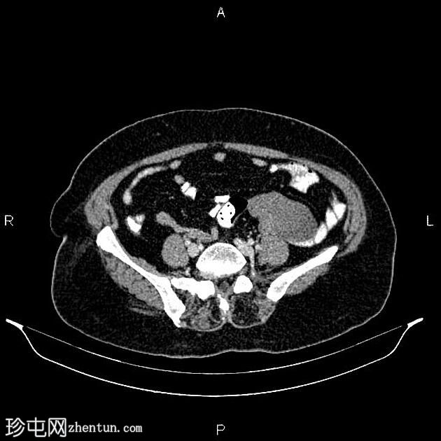 卵巢浆液性腺纤维瘤