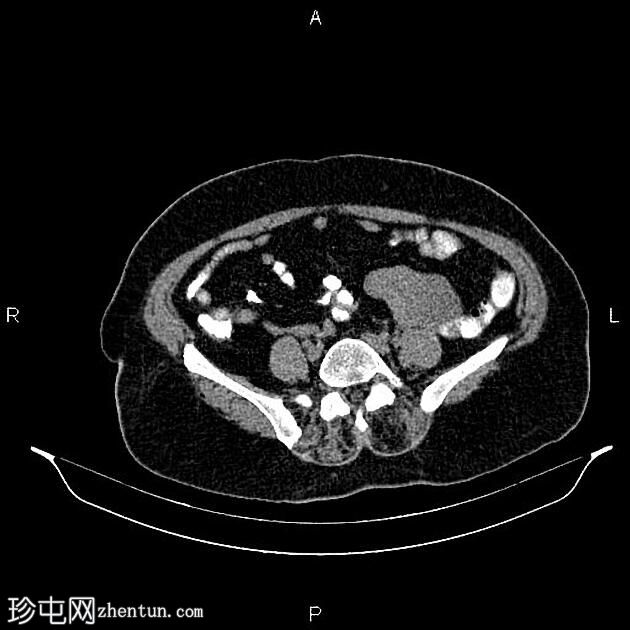 卵巢浆液性腺纤维瘤