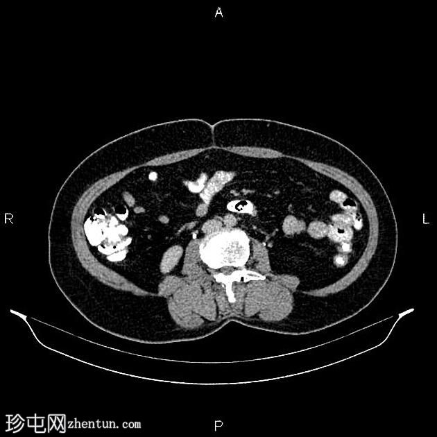 卵巢浆液性腺纤维瘤