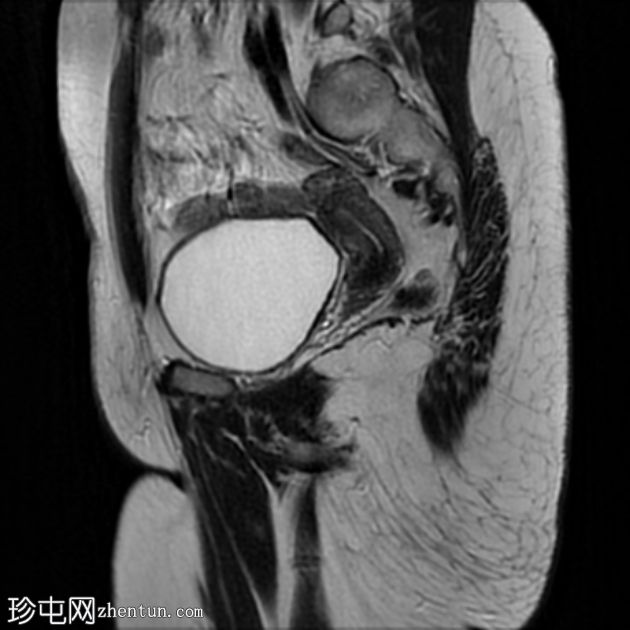 促性腺激素功能低下