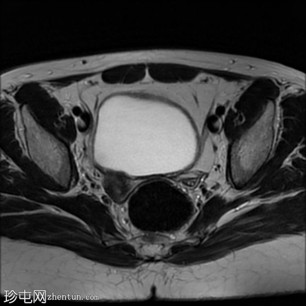 促性腺激素功能低下