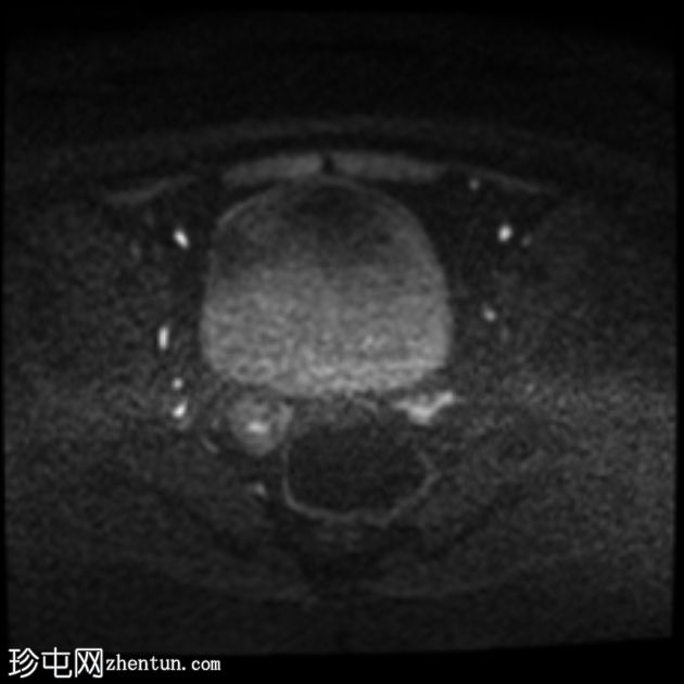 促性腺激素功能低下