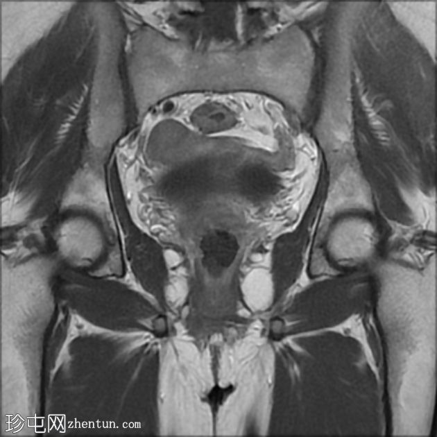 促性腺激素功能低下