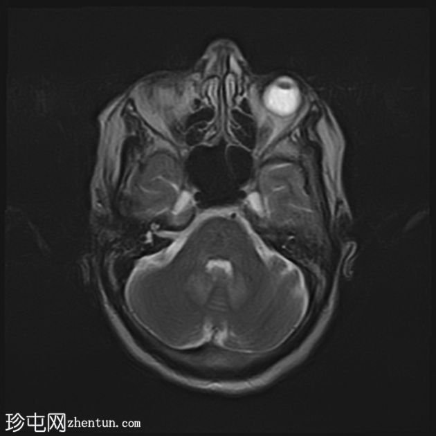 甲硝唑诱发的脑病