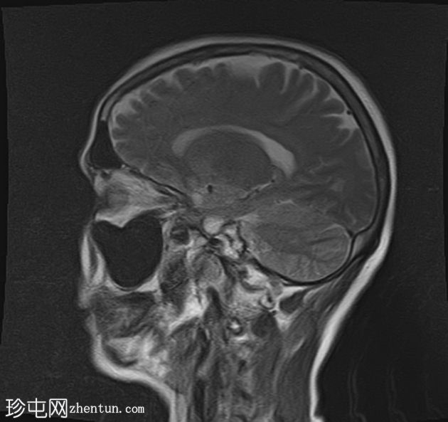 甲硝唑诱发的脑病