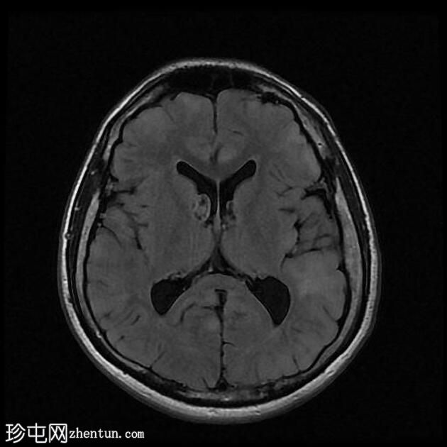 结节性硬化症