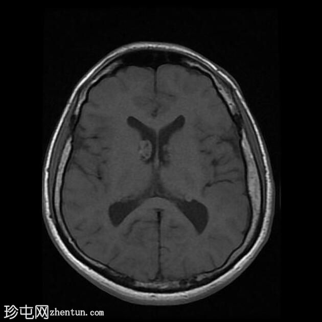 结节性硬化症