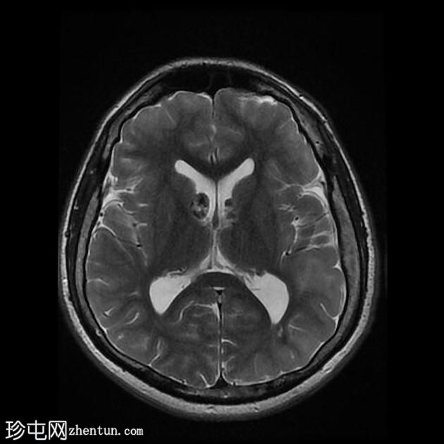 结节性硬化症