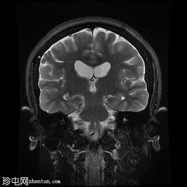 结节性硬化症