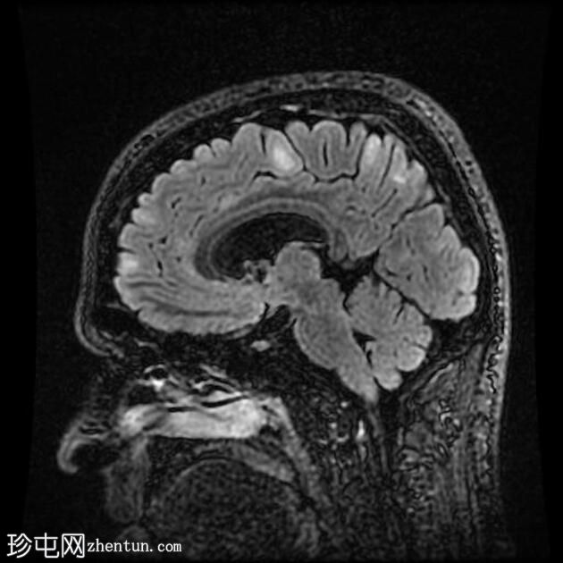 结节性硬化症