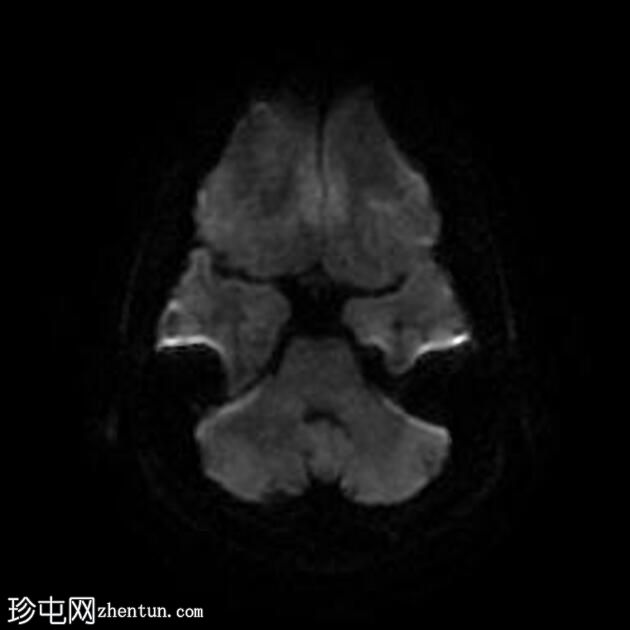 结节性硬化症