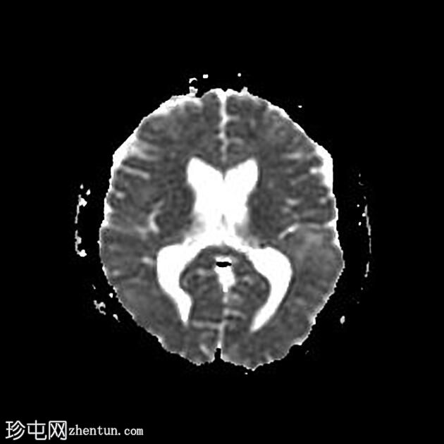 结节性硬化症