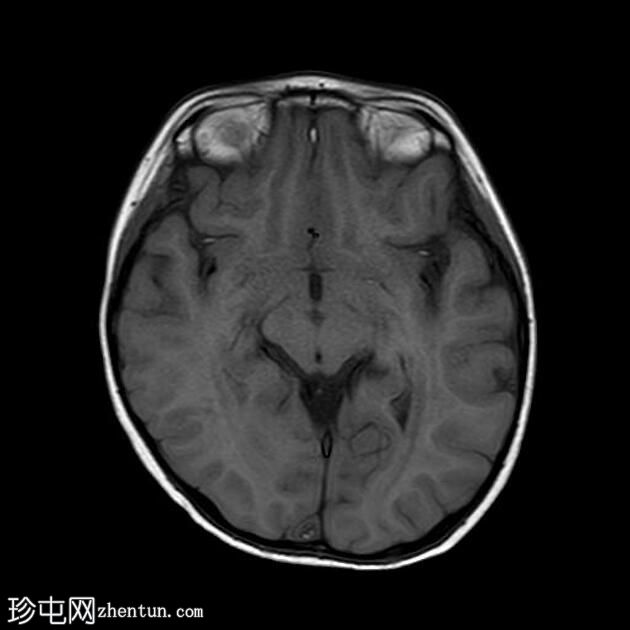 异染性脑白质营养不良