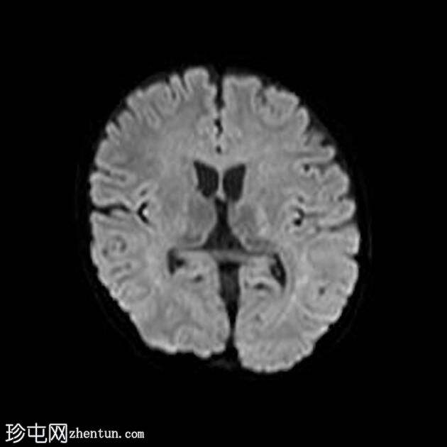 异染性脑白质营养不良