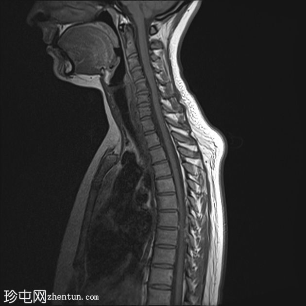 脊髓血管母细胞瘤