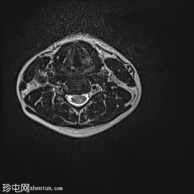 脊髓血管母细胞瘤