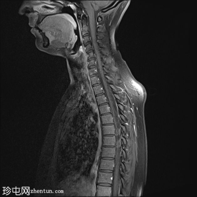 脊髓血管母细胞瘤