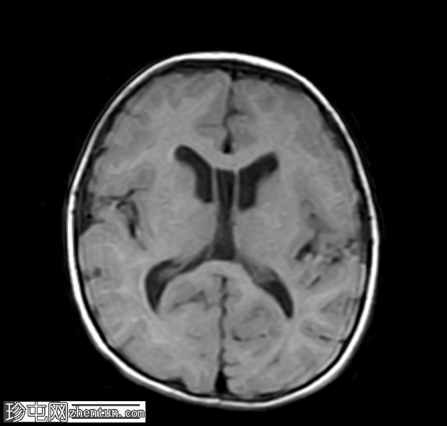 脑室周围白质软化，有出生窒息史