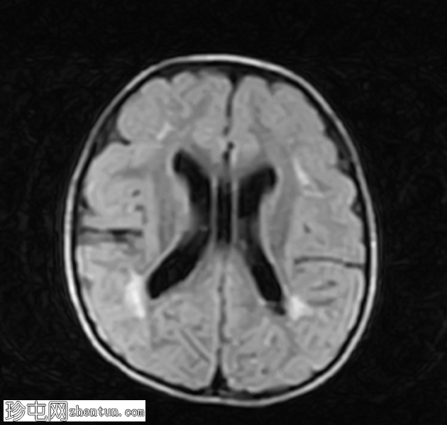 脑室周围白质软化，有出生窒息史