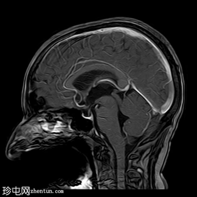 Bloomy rind征-软脑膜转移