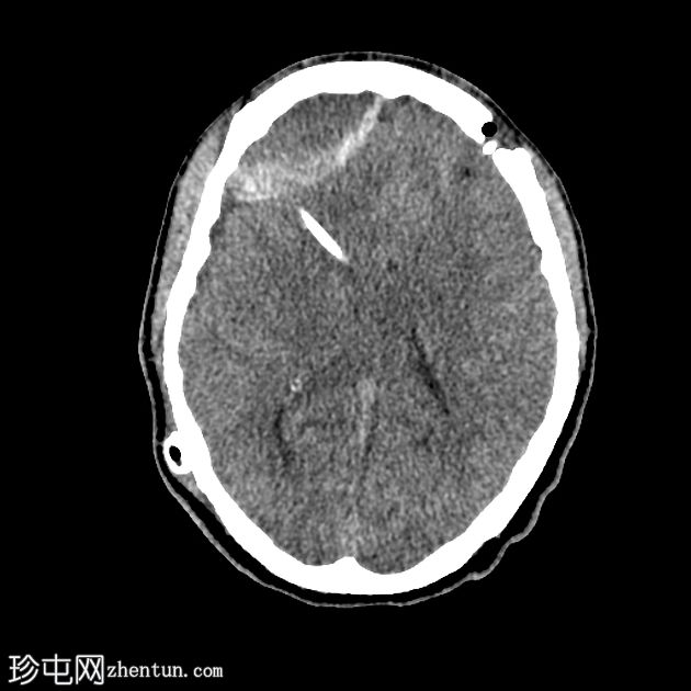 分流术后亚急性硬膜外血肿
